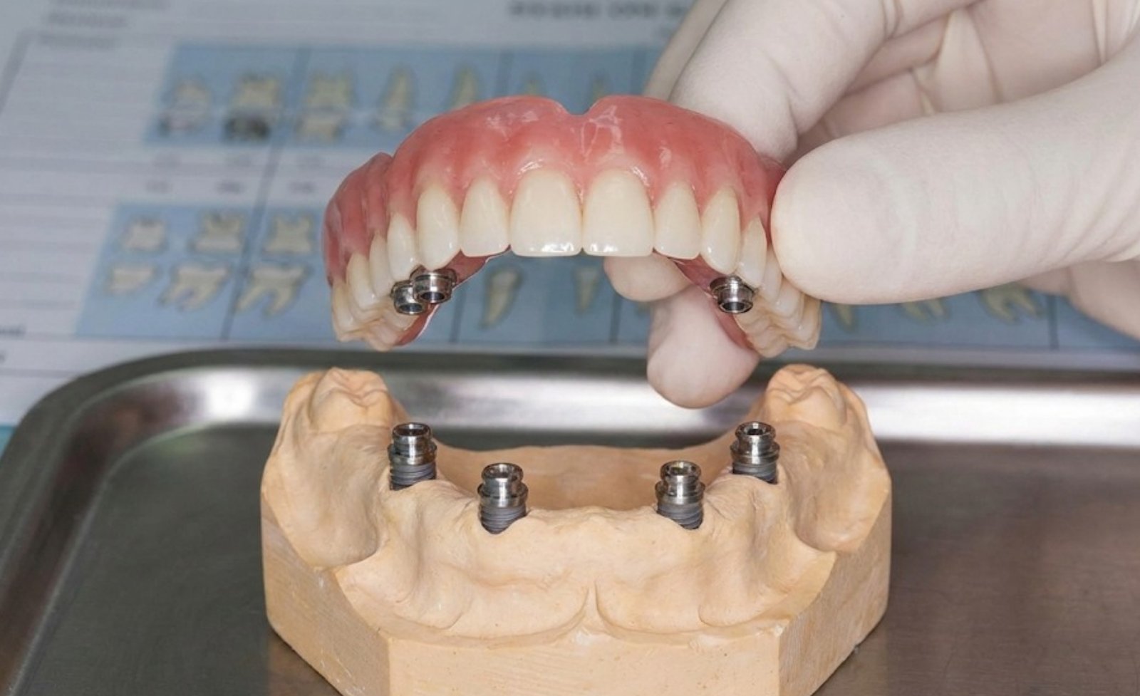 Implant Supported Overdentures